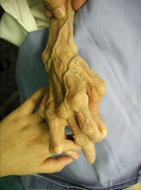 関節リウマチによる手の変形